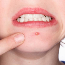 “Pimple talk” themselves